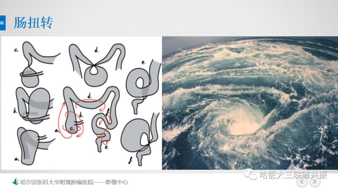 影像PPT - 【PPT】急腹症影像学诊断-50