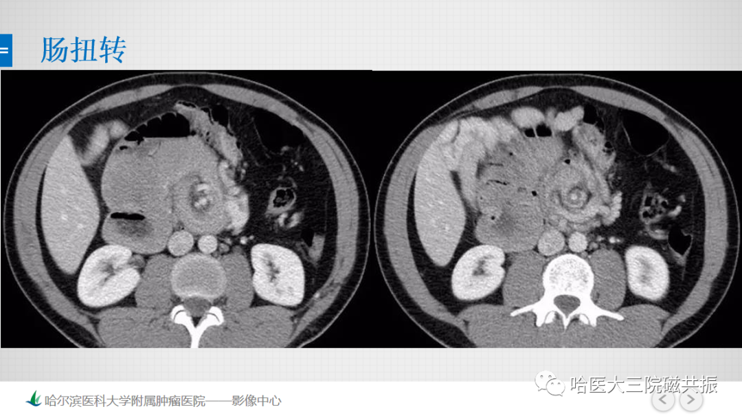 影像PPT - 【PPT】急腹症影像学诊断-51
