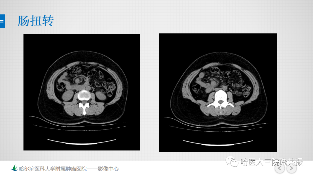 影像PPT - 【PPT】急腹症影像学诊断-52