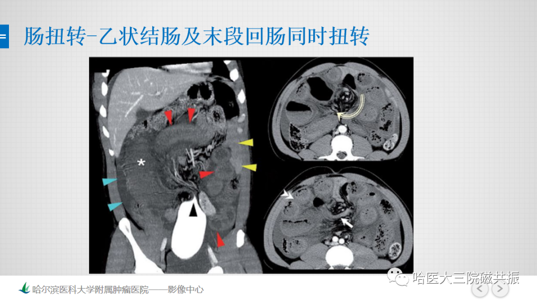 影像PPT - 【PPT】急腹症影像学诊断-53