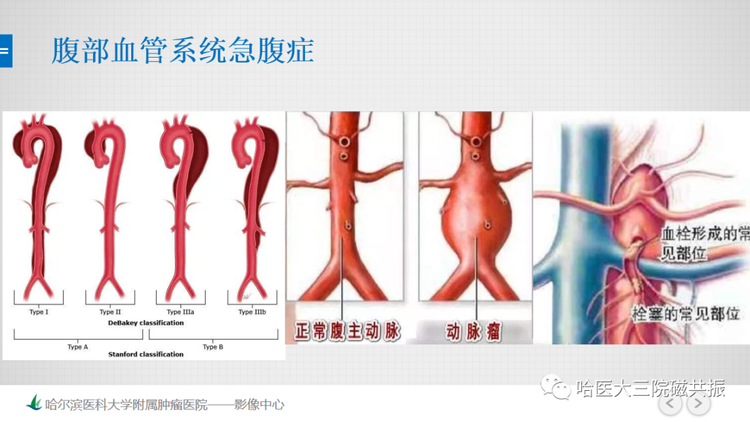 影像PPT - 【PPT】急腹症影像学诊断-54