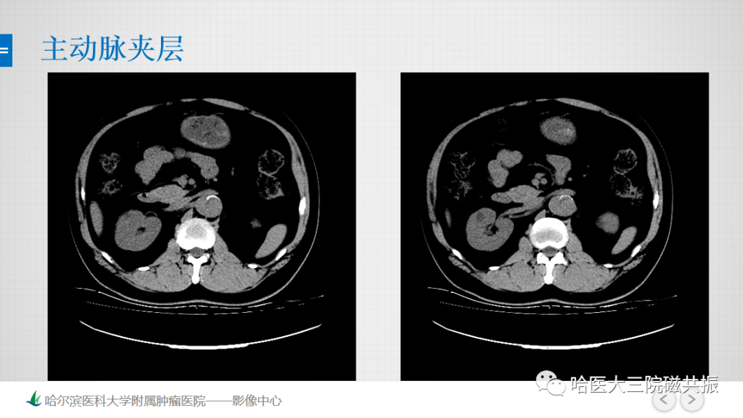 影像PPT - 【PPT】急腹症影像学诊断-56