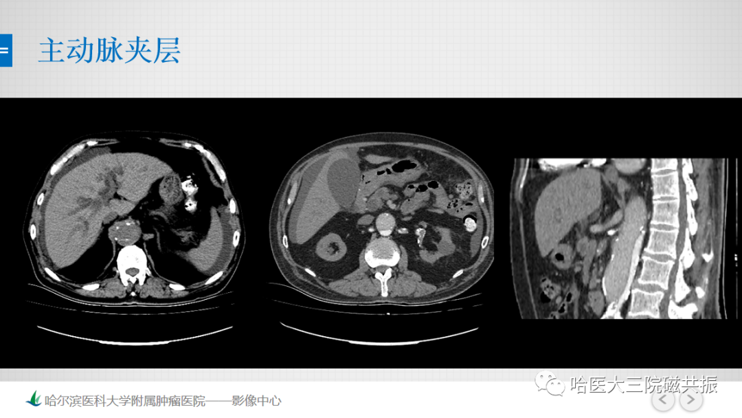 影像PPT - 【PPT】急腹症影像学诊断-57