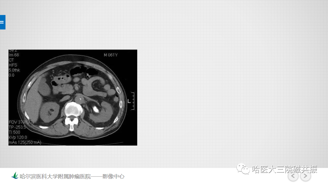 影像PPT - 【PPT】急腹症影像学诊断-58