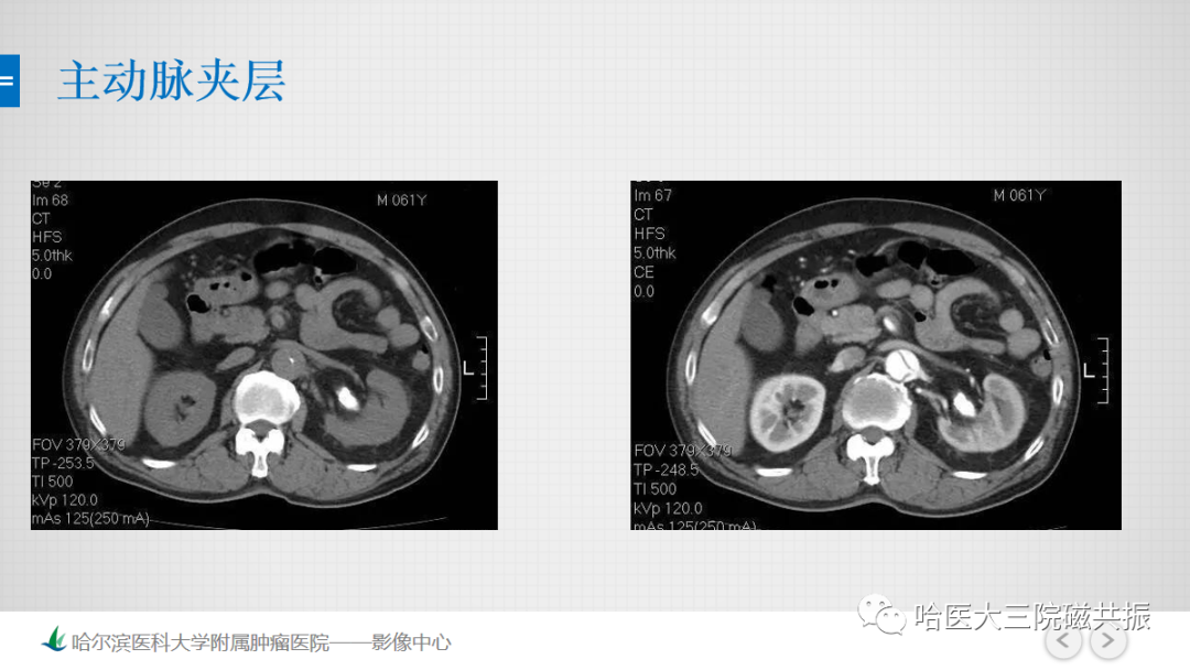 影像PPT - 【PPT】急腹症影像学诊断-59