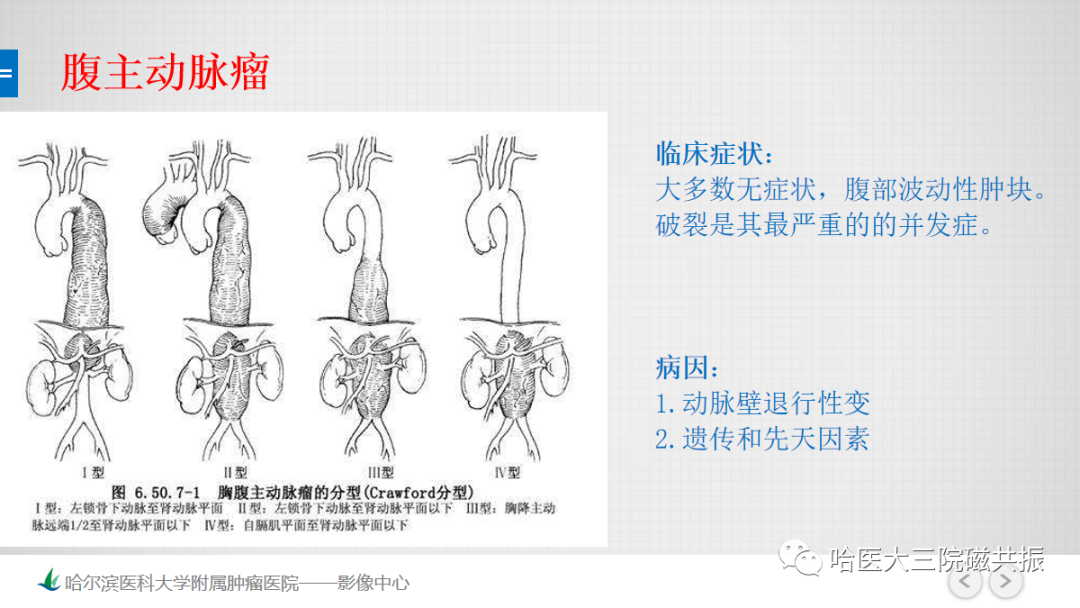 影像PPT - 【PPT】急腹症影像学诊断-60