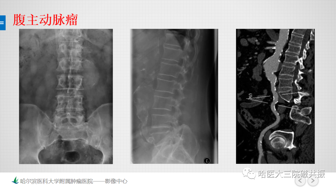 影像PPT - 【PPT】急腹症影像学诊断-61
