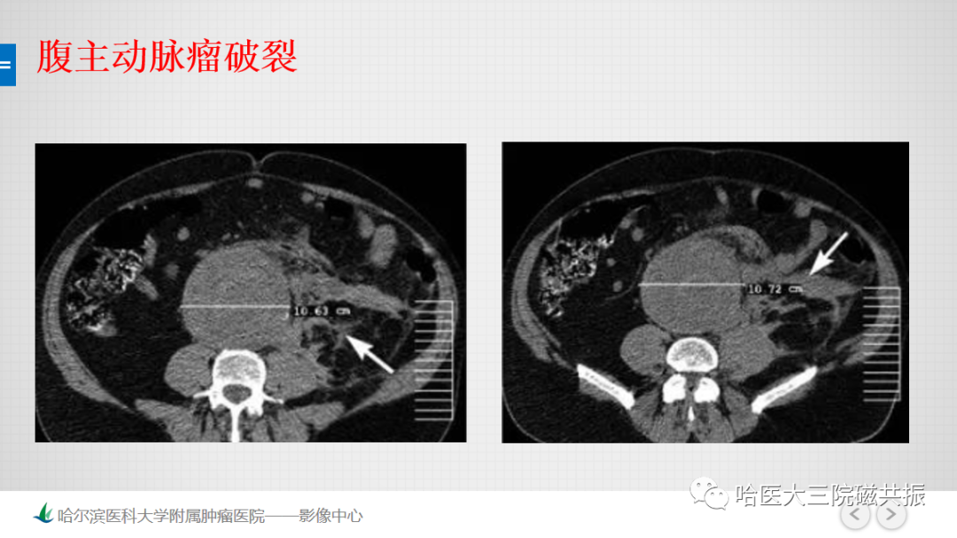 影像PPT - 【PPT】急腹症影像学诊断-62