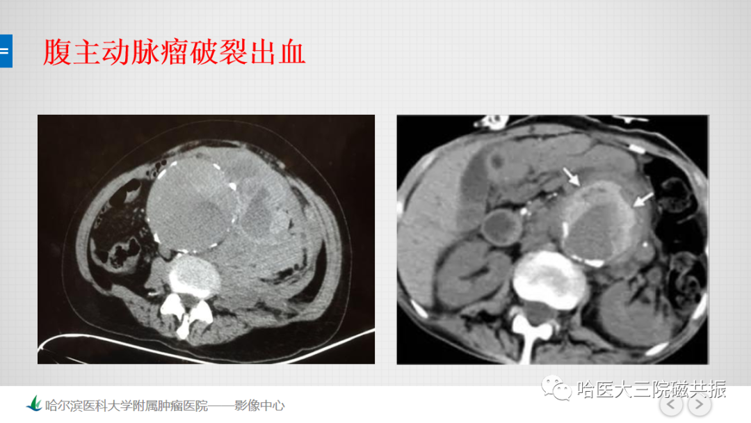 影像PPT - 【PPT】急腹症影像学诊断-63