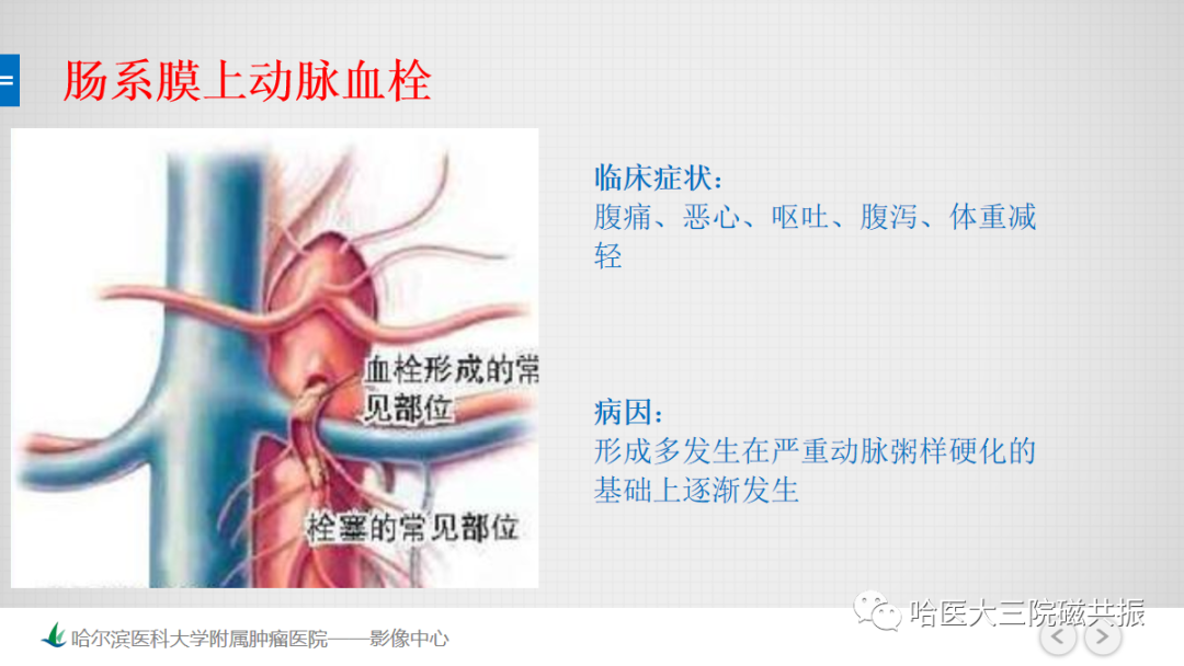 影像PPT - 【PPT】急腹症影像学诊断-64