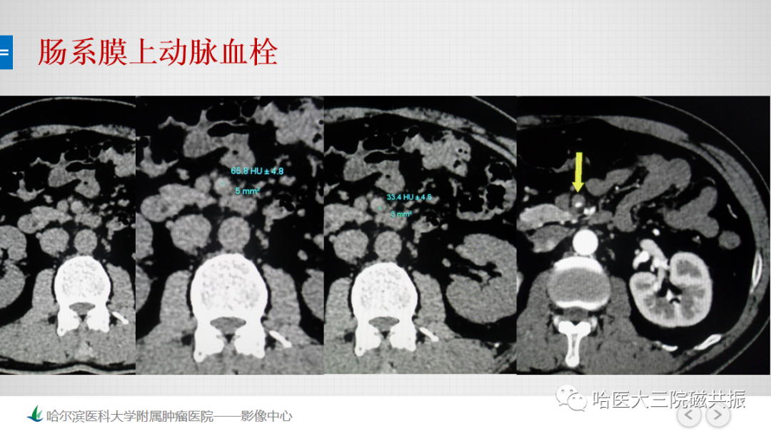 影像PPT - 【PPT】急腹症影像学诊断-65