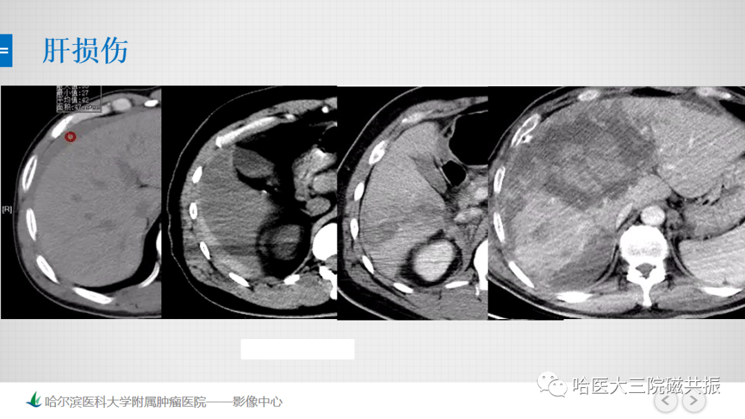 影像PPT - 【PPT】急腹症影像学诊断-68