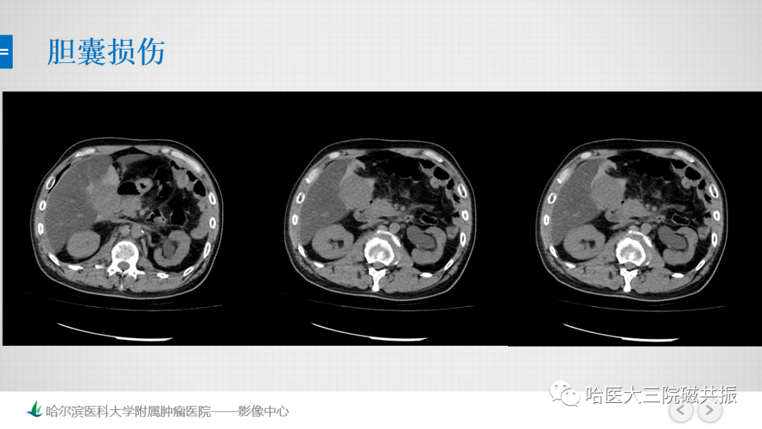影像PPT - 【PPT】急腹症影像学诊断-69