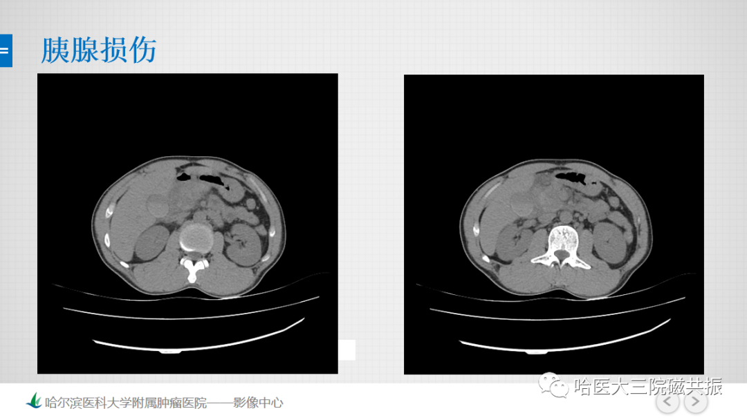 影像PPT - 【PPT】急腹症影像学诊断-71
