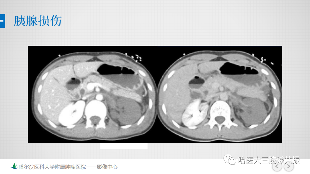 影像PPT - 【PPT】急腹症影像学诊断-72