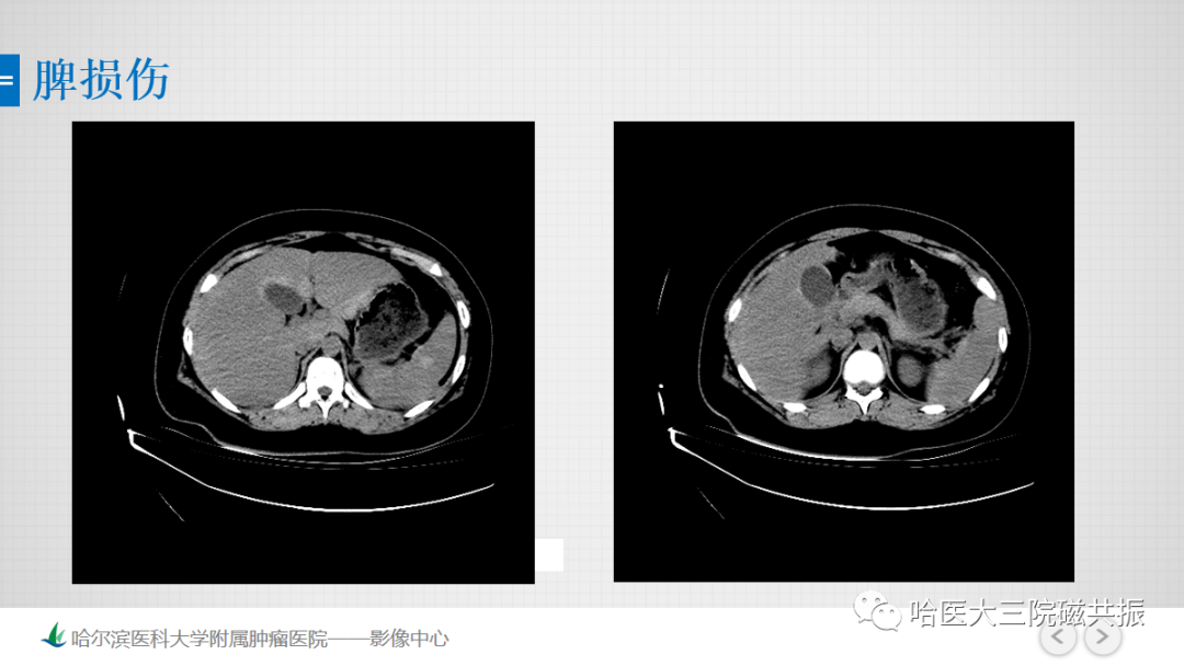 影像PPT - 【PPT】急腹症影像学诊断-74