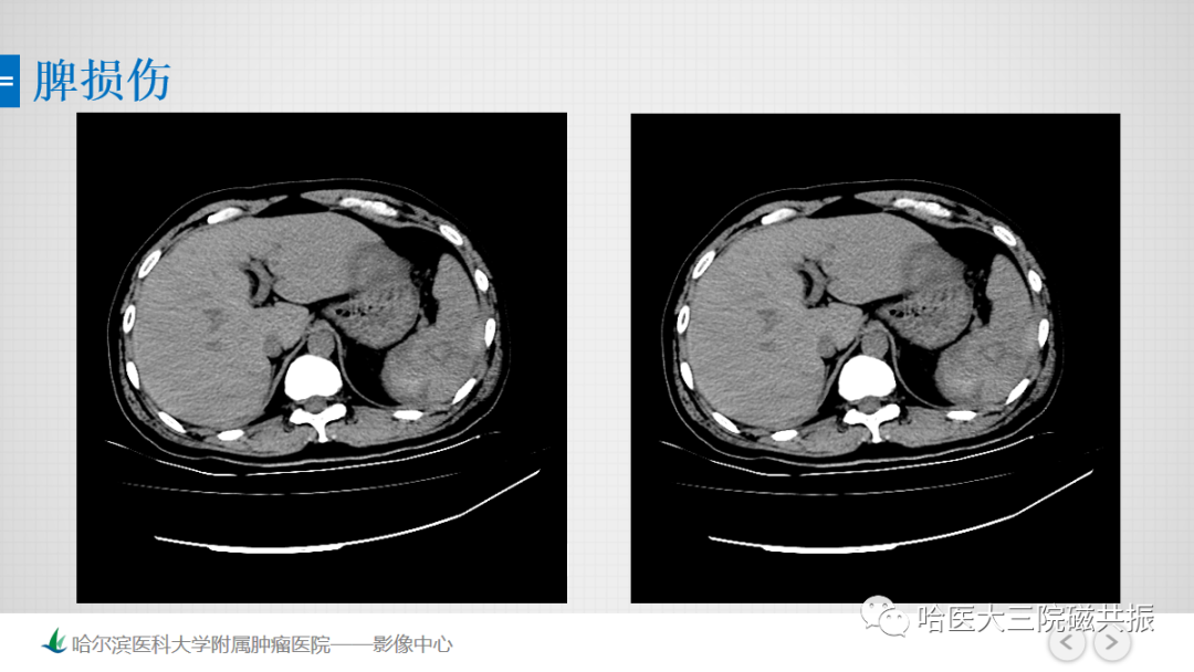 影像PPT - 【PPT】急腹症影像学诊断-75