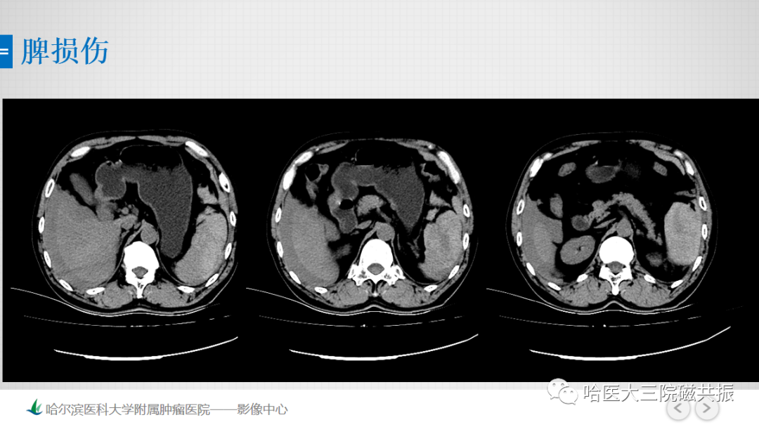 影像PPT - 【PPT】急腹症影像学诊断-76