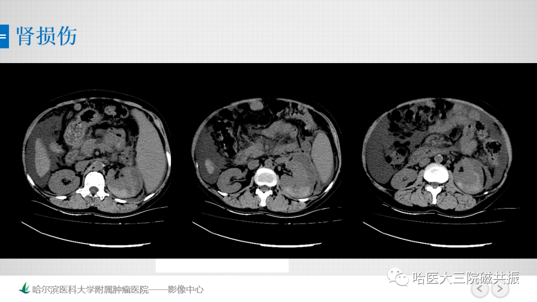 影像PPT - 【PPT】急腹症影像学诊断-78