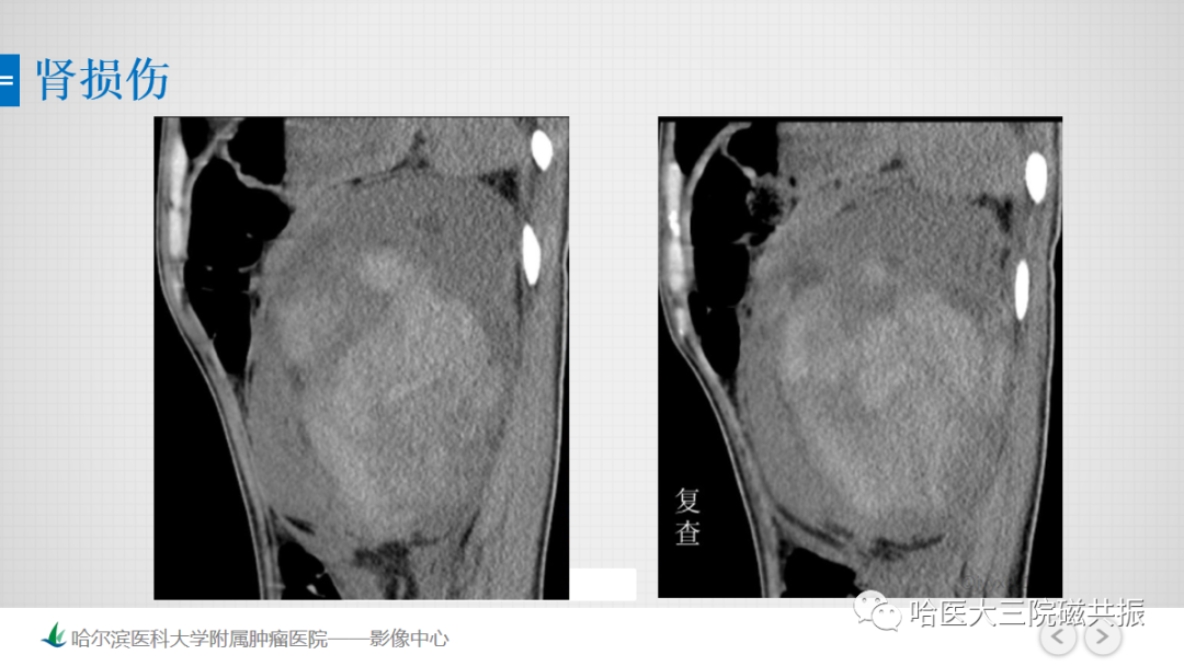 影像PPT - 【PPT】急腹症影像学诊断-80
