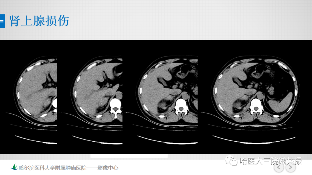 影像PPT - 【PPT】急腹症影像学诊断-81