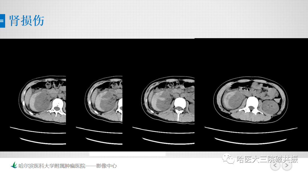 影像PPT - 【PPT】急腹症影像学诊断-79