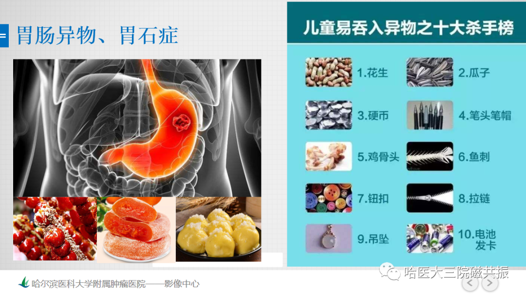 影像PPT - 【PPT】急腹症影像学诊断-82