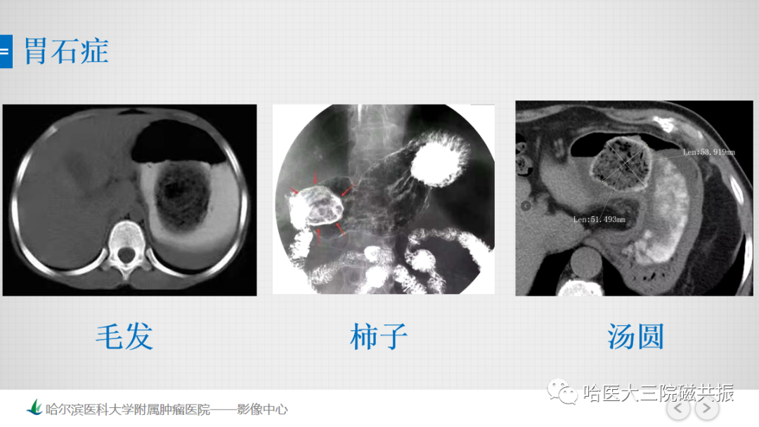 影像PPT - 【PPT】急腹症影像学诊断-84