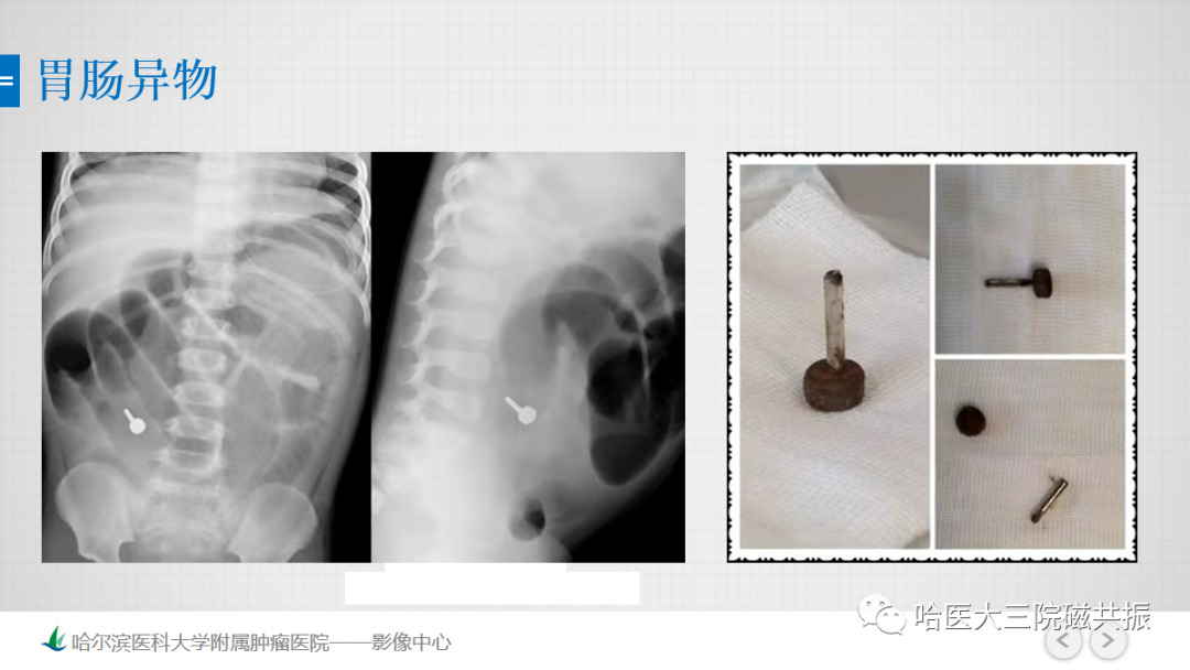 影像PPT - 【PPT】急腹症影像学诊断-85