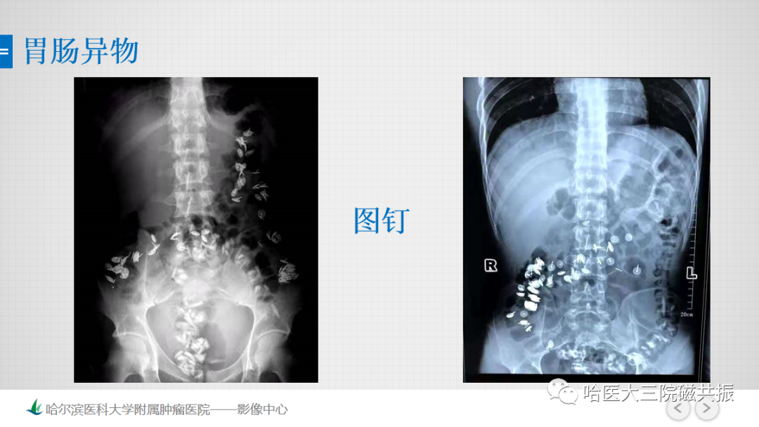 影像PPT - 【PPT】急腹症影像学诊断-86