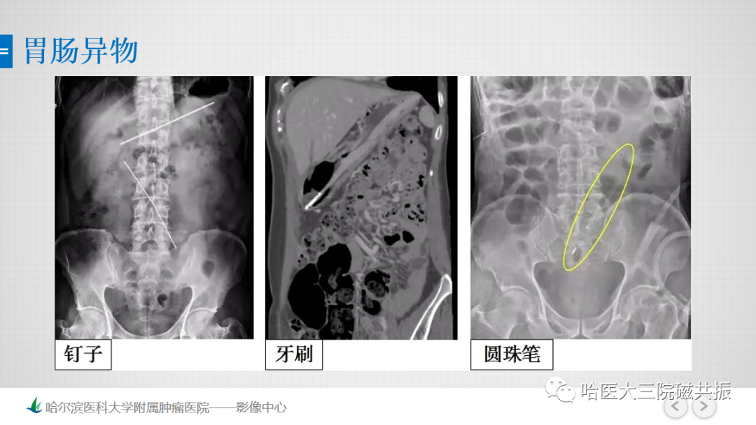 影像PPT - 【PPT】急腹症影像学诊断-87