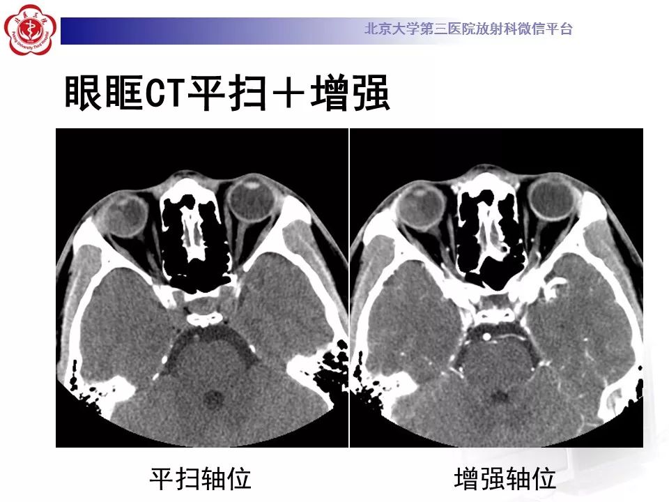 影像PPT - 【PPT】Coats病影像-3