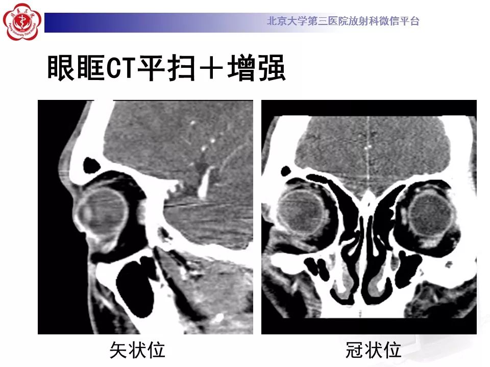 影像PPT - 【PPT】Coats病影像-4