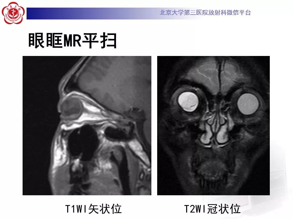 影像PPT - 【PPT】Coats病影像-6