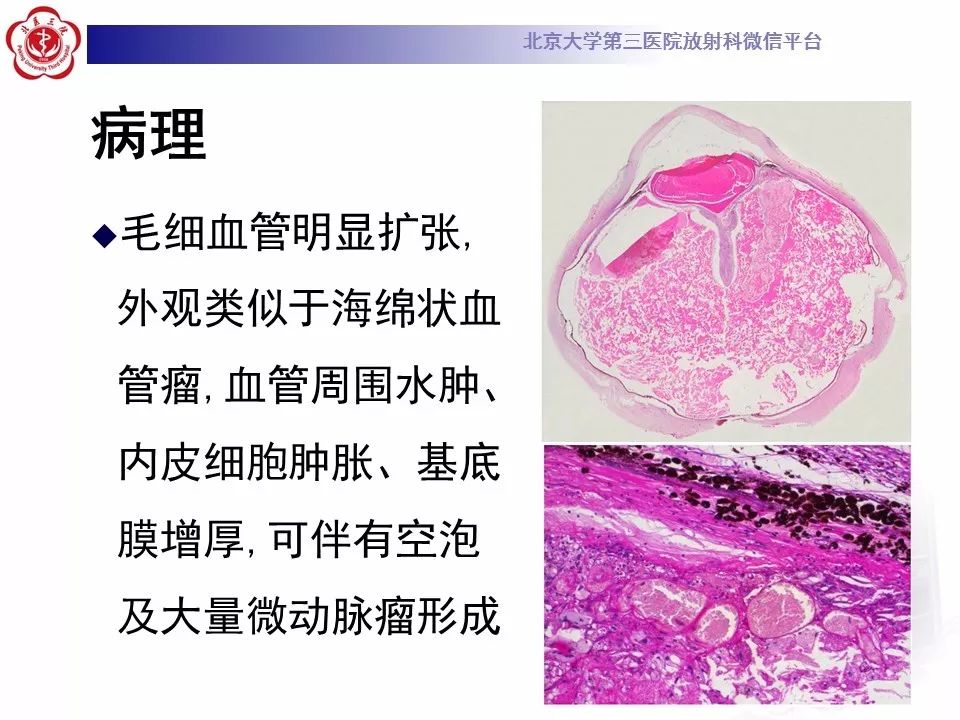 影像PPT - 【PPT】Coats病影像-13