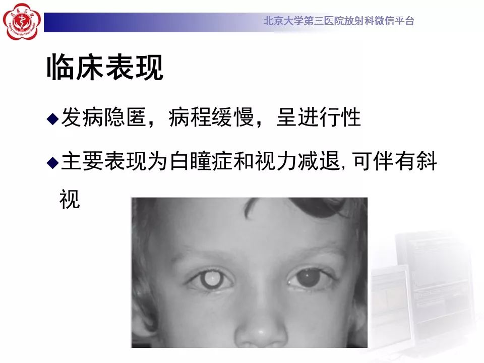 影像PPT - 【PPT】Coats病影像-14