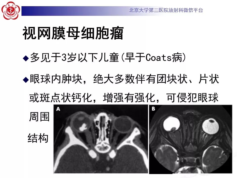 影像PPT - 【PPT】Coats病影像-20
