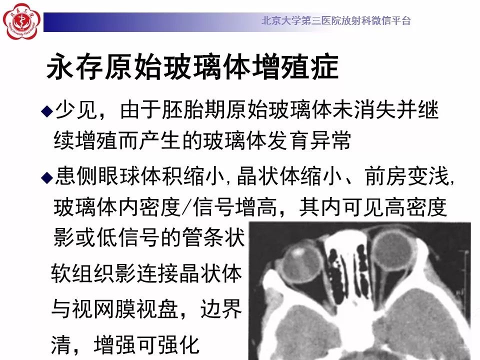 影像PPT - 【PPT】Coats病影像-21