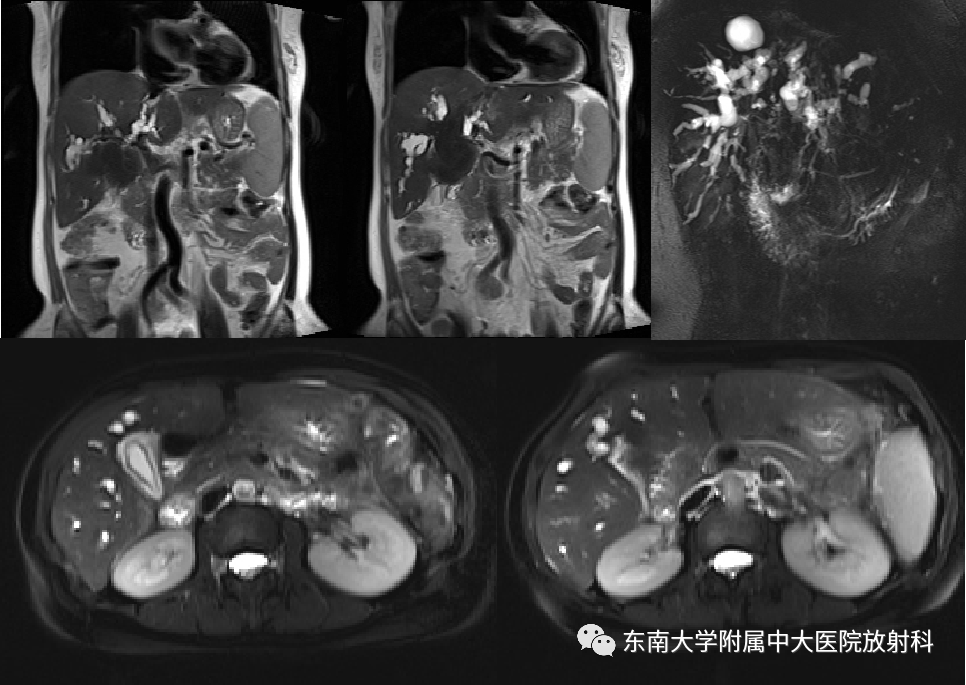 影像PPT - 【病例】胆管狭窄3例X线CT及MR病例随访-3 影像PPT - 【病例】胆管狭窄3例X线CT及MR病例随访-3