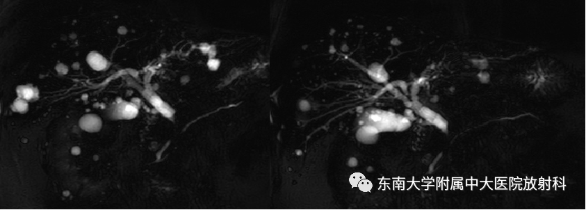 影像PPT - 【病例】胆管狭窄3例X线CT及MR病例随访-6 影像PPT - 【病例】胆管狭窄3例X线CT及MR病例随访-6