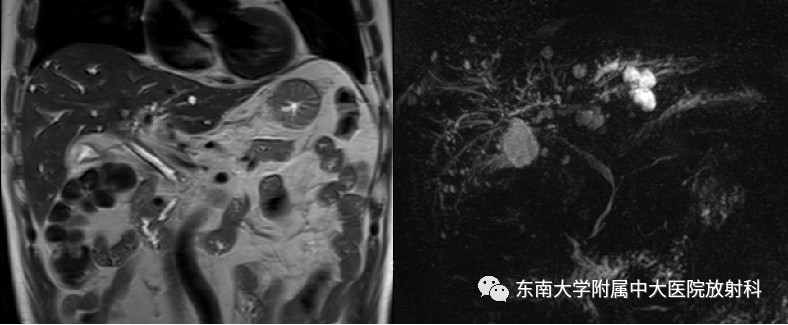 影像PPT - 【病例】胆管狭窄3例X线CT及MR病例随访-7 影像PPT - 【病例】胆管狭窄3例X线CT及MR病例随访-7
