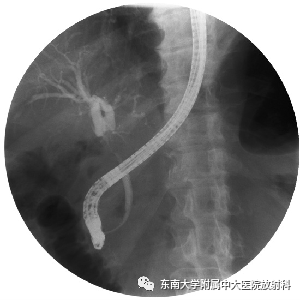 影像PPT - 【病例】胆管狭窄3例X线CT及MR病例随访-9 影像PPT - 【病例】胆管狭窄3例X线CT及MR病例随访-9