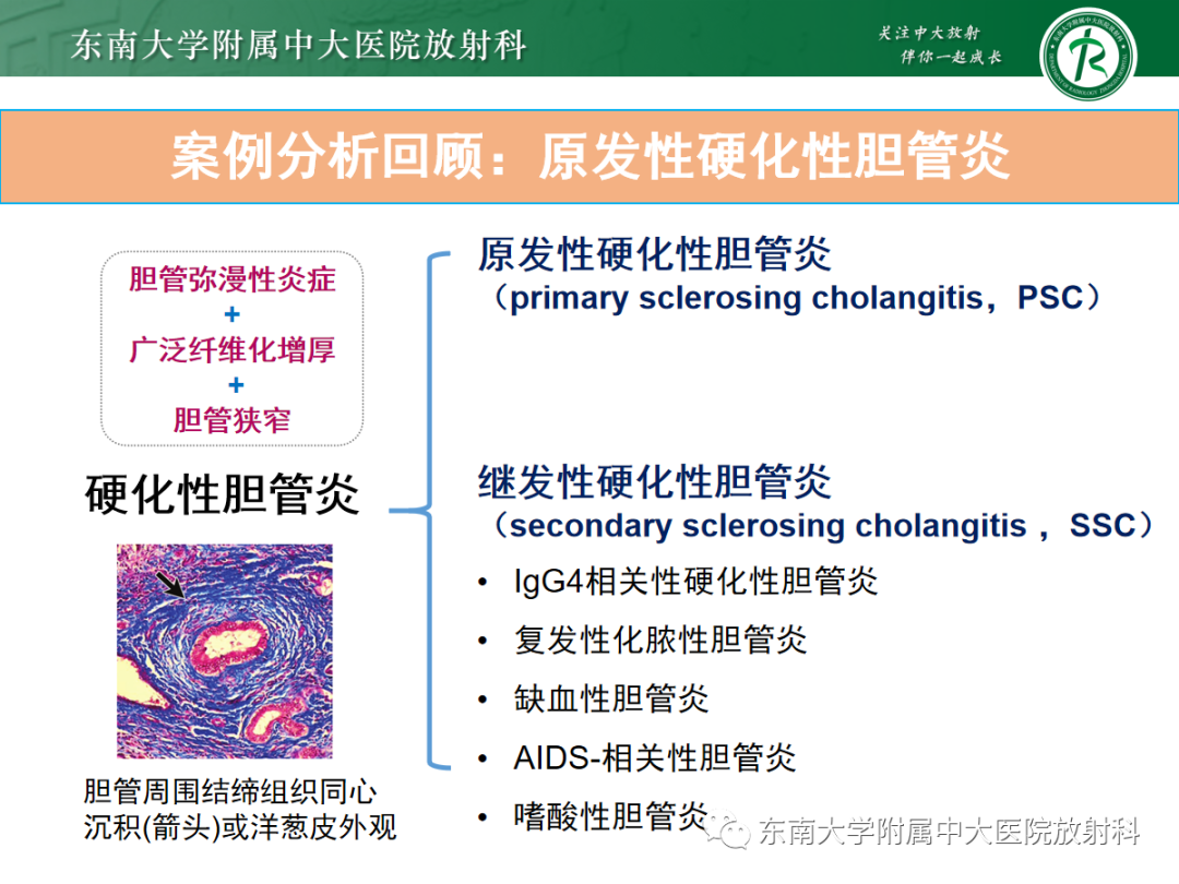 影像PPT - 【病例】胆管狭窄3例X线CT及MR病例随访-21 影像PPT - 【病例】胆管狭窄3例X线CT及MR病例随访-21