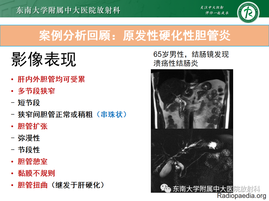 影像PPT - 【病例】胆管狭窄3例X线CT及MR病例随访-24 影像PPT - 【病例】胆管狭窄3例X线CT及MR病例随访-24