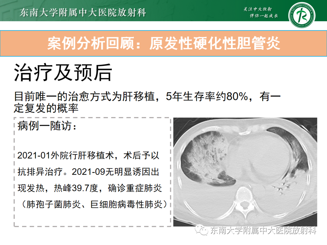 影像PPT - 【病例】胆管狭窄3例X线CT及MR病例随访-25 影像PPT - 【病例】胆管狭窄3例X线CT及MR病例随访-25