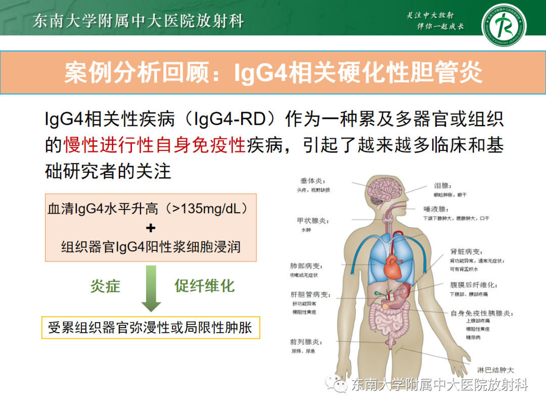影像PPT - 【病例】胆管狭窄3例X线CT及MR病例随访-26 影像PPT - 【病例】胆管狭窄3例X线CT及MR病例随访-26
