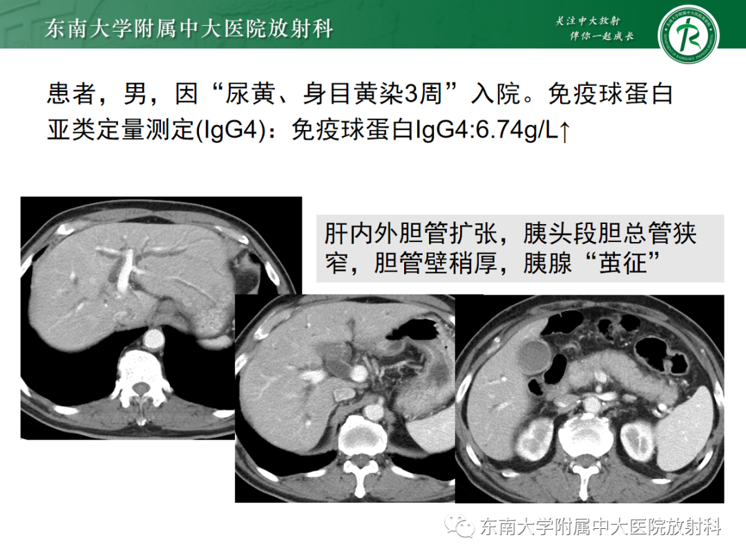 影像PPT - 【病例】胆管狭窄3例X线CT及MR病例随访-29 影像PPT - 【病例】胆管狭窄3例X线CT及MR病例随访-29