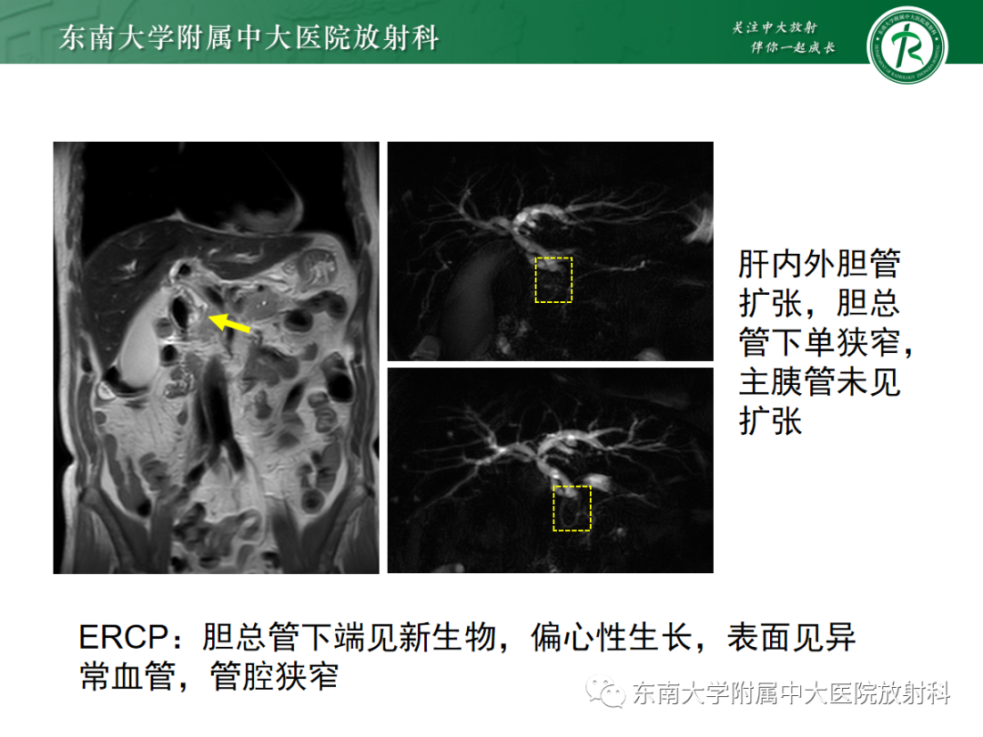 影像PPT - 【病例】胆管狭窄3例X线CT及MR病例随访-30 影像PPT - 【病例】胆管狭窄3例X线CT及MR病例随访-30