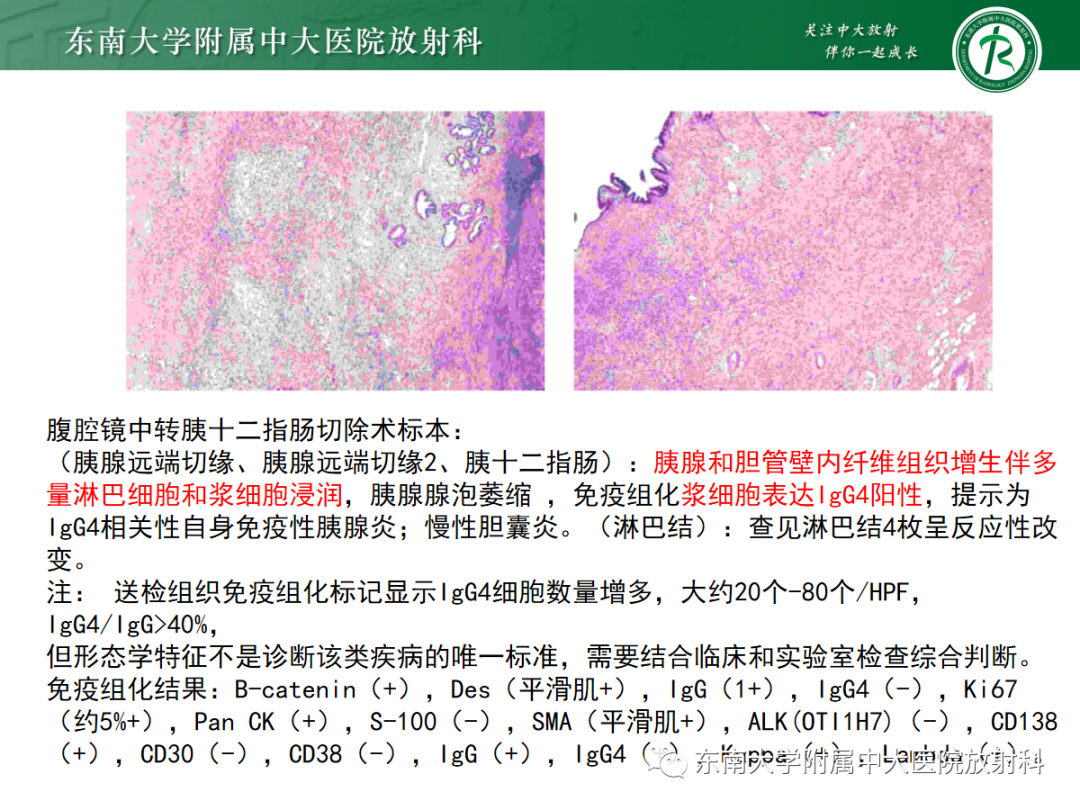 影像PPT - 【病例】胆管狭窄3例X线CT及MR病例随访-31 影像PPT - 【病例】胆管狭窄3例X线CT及MR病例随访-31