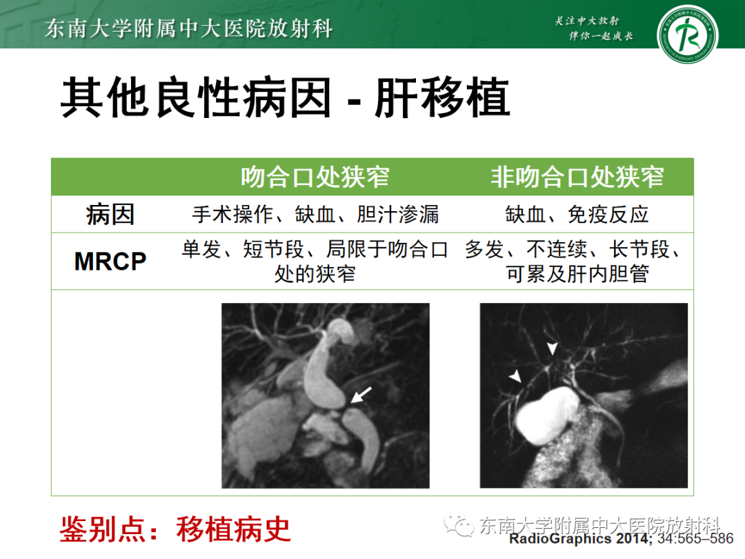 影像PPT - 【病例】胆管狭窄3例X线CT及MR病例随访-34 影像PPT - 【病例】胆管狭窄3例X线CT及MR病例随访-34